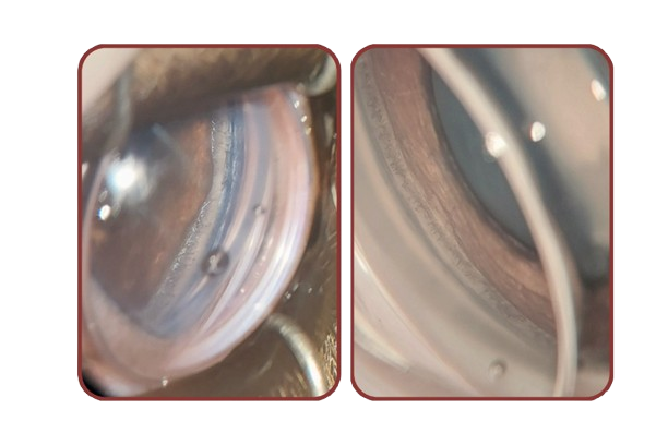 Gonioscopia